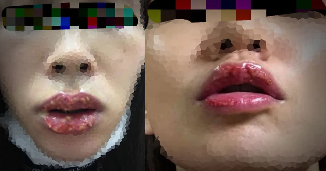 พิษศัลยกรรม ! สาวร้องสักปากชมพูคลินิกพริตตี้ดัง ทำติดเชื้อเป็นหนอง