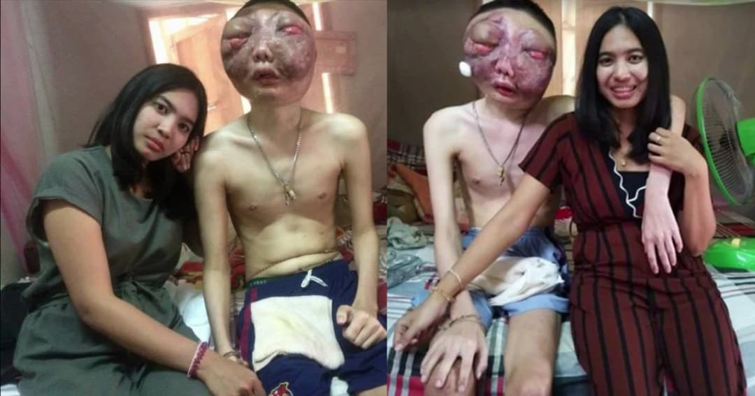 สุดเศร้า! หนุ่มป่วยมะเร็งใบหน้าเสียชีวิตแล้ว แฟนสาวเผยรักกันจนวินาทีสุดท้าย