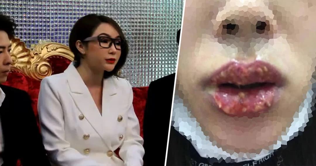 ‘นิกกี้’ พริตตี้เงินล้านแจง ลูกค้าสักปากติดเชื้อ ยันร้านสะอาด ไม่ได้ไปเยี่ยมเพราะนมเป็นหนอง