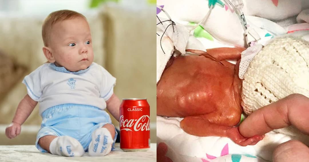 ทารกตัวเล็กที่สุดในอังกฤษ น้ำหนักตอนเกิดเท่าน้ำอัดลม 1 กระป๋อง