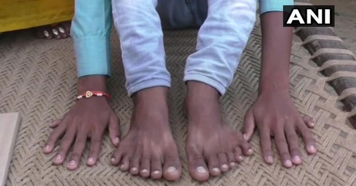 เด็กอินเดียพิการ มี 12 นิ้วมือ 12 นิ้วเท้า ถูกไล่จับบูชายัญ หวังร่ำรวย