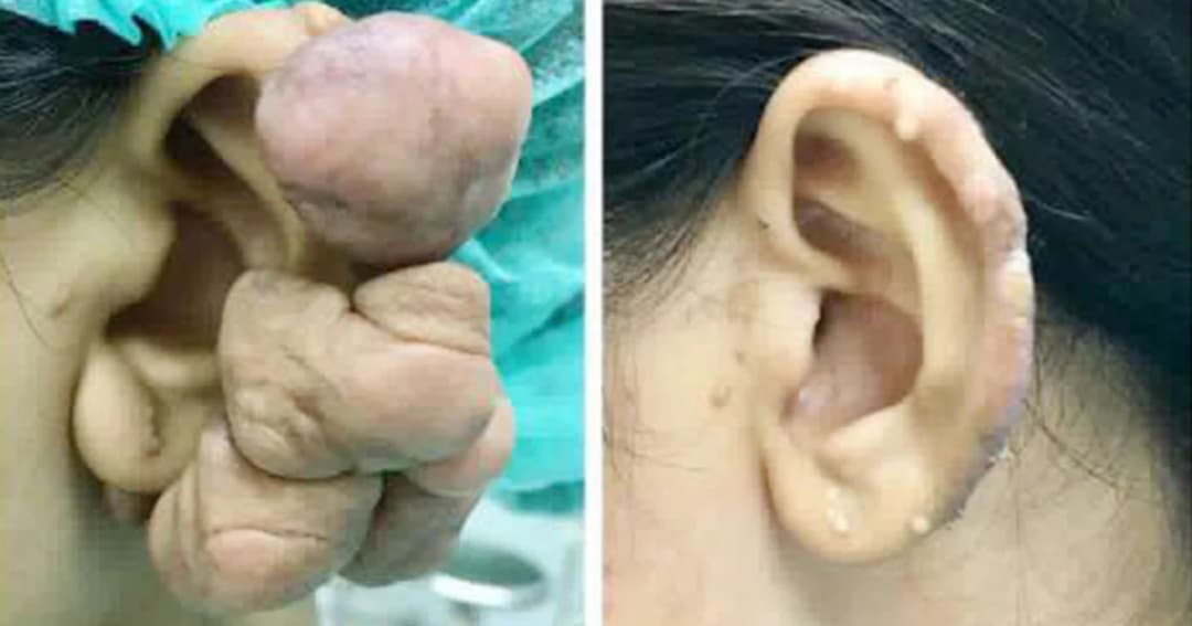 เตือน! เจาะหูหลายรูระวัง “คีลอยด์” โผล่ออกมาเป็นพวง