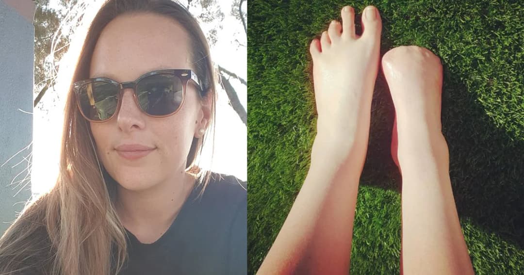 สาวออสซี่ ถูกตัด 5 นิ้วเท้า หลังติดเชื้อกินกระดูก อ้างแช่ ‘สปาปลา’ ในไทย