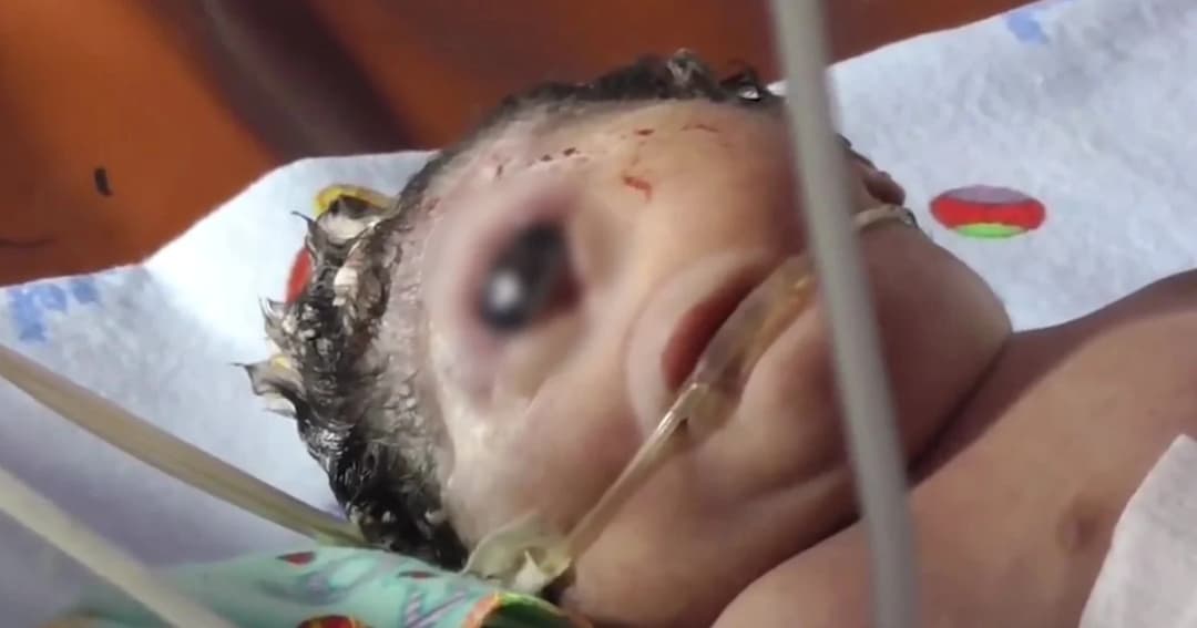 เศร้า! ลูกเกิดมามีตาเดียว-ไม่มีจมูก ก่อนเสียชีวิต หลังลืมตาดูโลกเพียง 7 ชม.