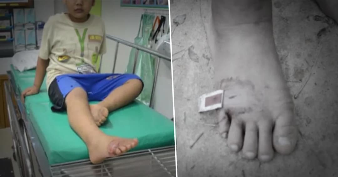 ผู้ปกครองโวย ! ลูกชาย ป.1 ถูกเพื่อนใช้ไม้แทงเท้าเป็นแผลลึก แต่ครูเมินช่วย