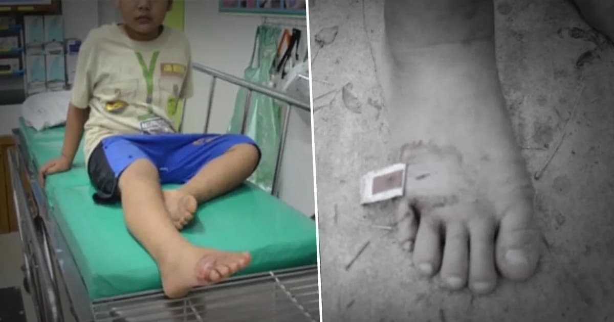 ผู้ปกครองโวย ! ลูกชาย ป.1 ถูกเพื่อนใช้ไม้แทงเท้าเป็นแผลลึก แต่ครูเมินช่วย