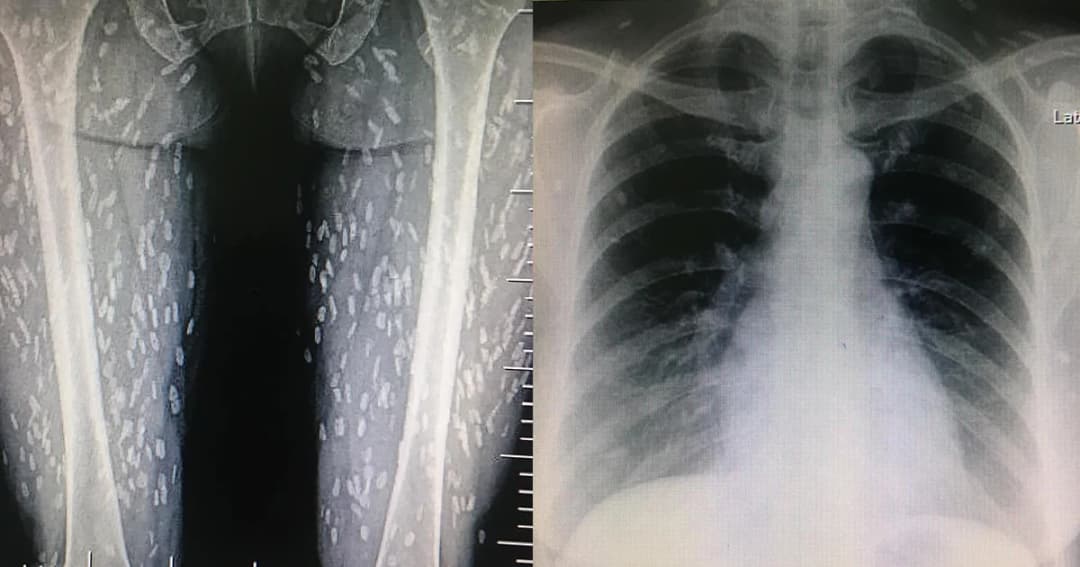 ขนลุก! แพทย์เผยฟิล์มเอ็กซเรย์คนไข้ พบ ‘พยาธิตืดหมู’ เต็มร่าง