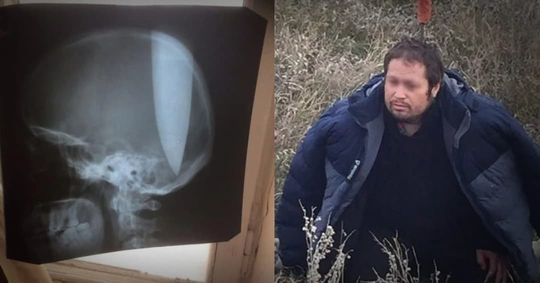 หนุ่มรัสเซียเอามีดแทงหัวตัวเอง เพราะหายใจไม่ออก