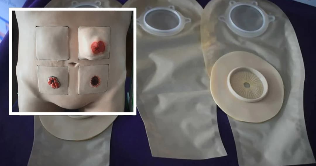 เเพทย์ รพ.สงขลานครินทร์ คิดค้น “อุปกรณ์รองรับสิ่งขับถ่ายจากทวารเทียม” ได้สำเร็จ