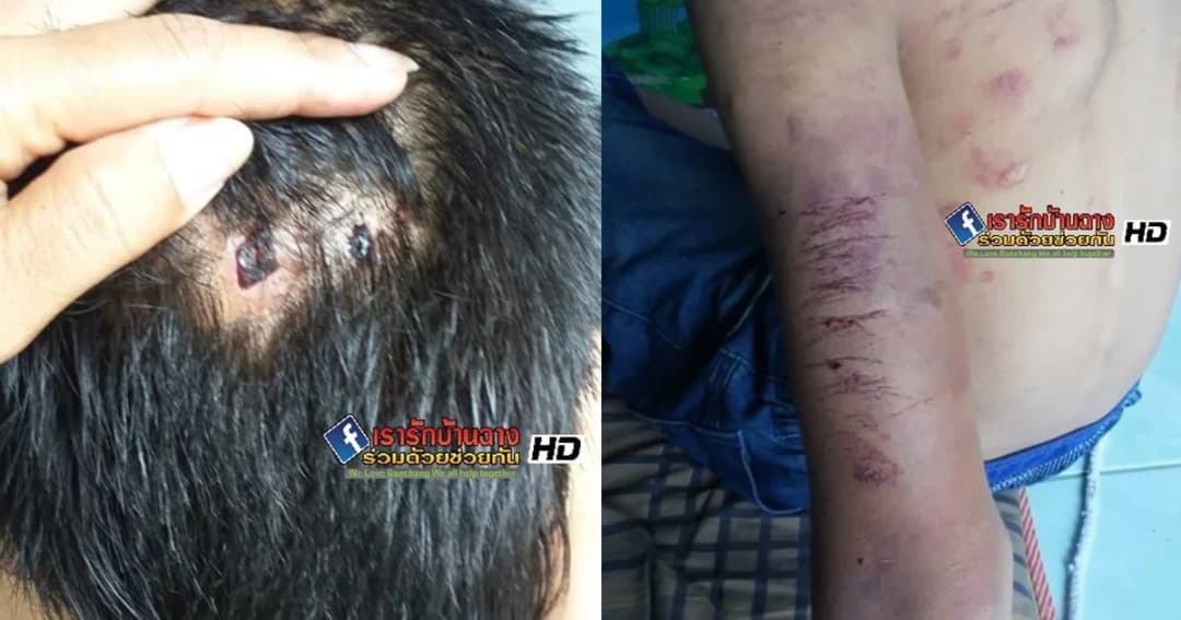 เด็กชาย ม.2 หนีตาย หลังถูกพ่อ – แม่เลี้ยงทารุณ ตั้งแต่หัวจรดเท้า