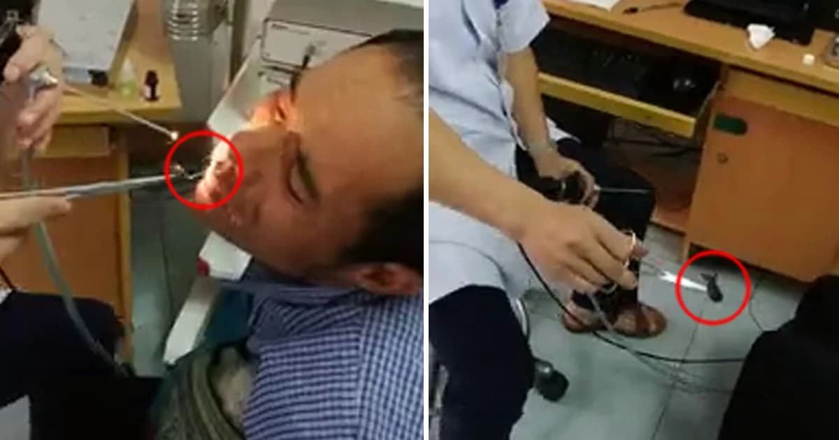 คลิปสยอง ! นาทีหมอเวียดนามดึงปลิงออกจากรูจมูกคนไข้