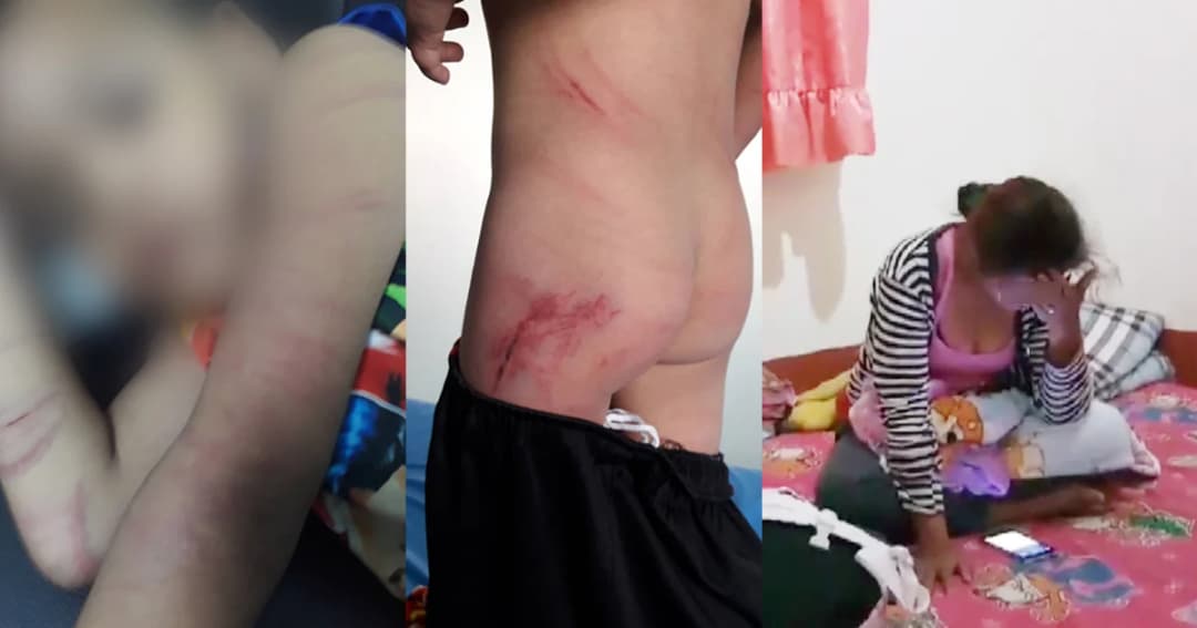 แม่โหด! ตีลูกวัย 4 ขวบ ไม่ยั้งจนด้ามไม่กวาดฉีก แผลเต็มตัว