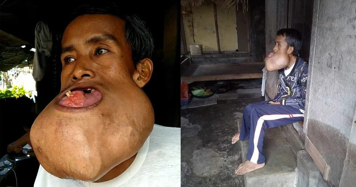 หนุ่มฟิลิปปินส์ป่วยเป็นเนื้องอกที่ปาก ขนาดเท่าลูกบอล