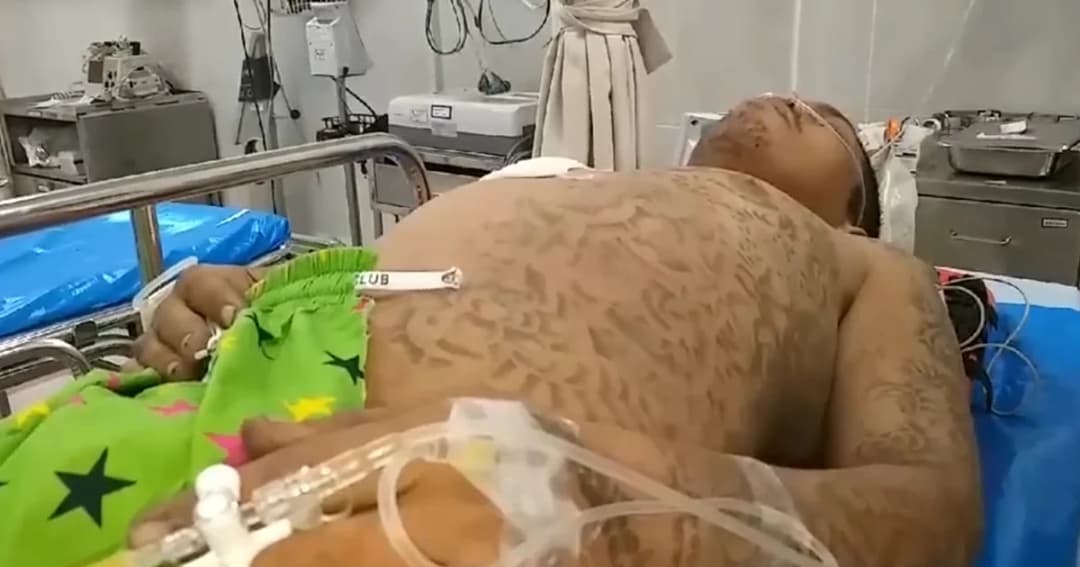 ขี่รถจักรยานยนต์ที่ขโมยมา พุ่งชนรถกระบะขาหักทั้ง 2 ข้าง