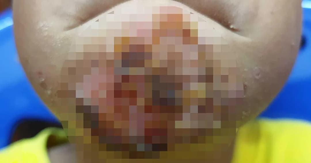 ด.ช. 6 ขวบ มีตุ่มที่คาง ญาติพาไปรักษาหมอบ้านจนแผลติดเชื้อรุนแรง