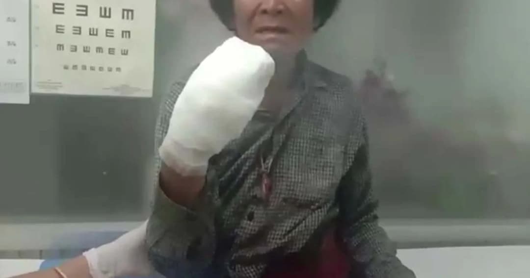 ยายเมืองชลวัย 71 ปาระเบิดปิงปองไล่นก พลาดบึ้มใส่มือนิ้วขาดเกือบหมด