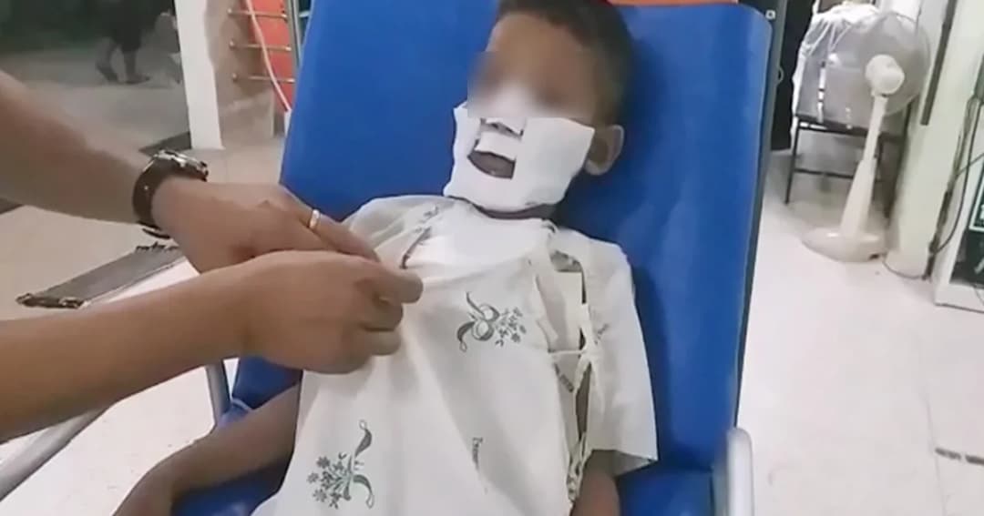 อุทาหรณ์! ด.ช. 4 ขวบ โยนไฟแช็คเข้ากองไฟเผาขยะ ถูกไฟลุกไหม้ทั่วตัวสาหัส