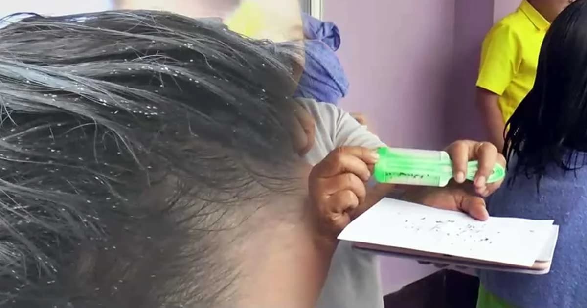 พบ “เหา” ระบาดในเด็กนักเรียนสระบุรี กว่า 2,300 คน