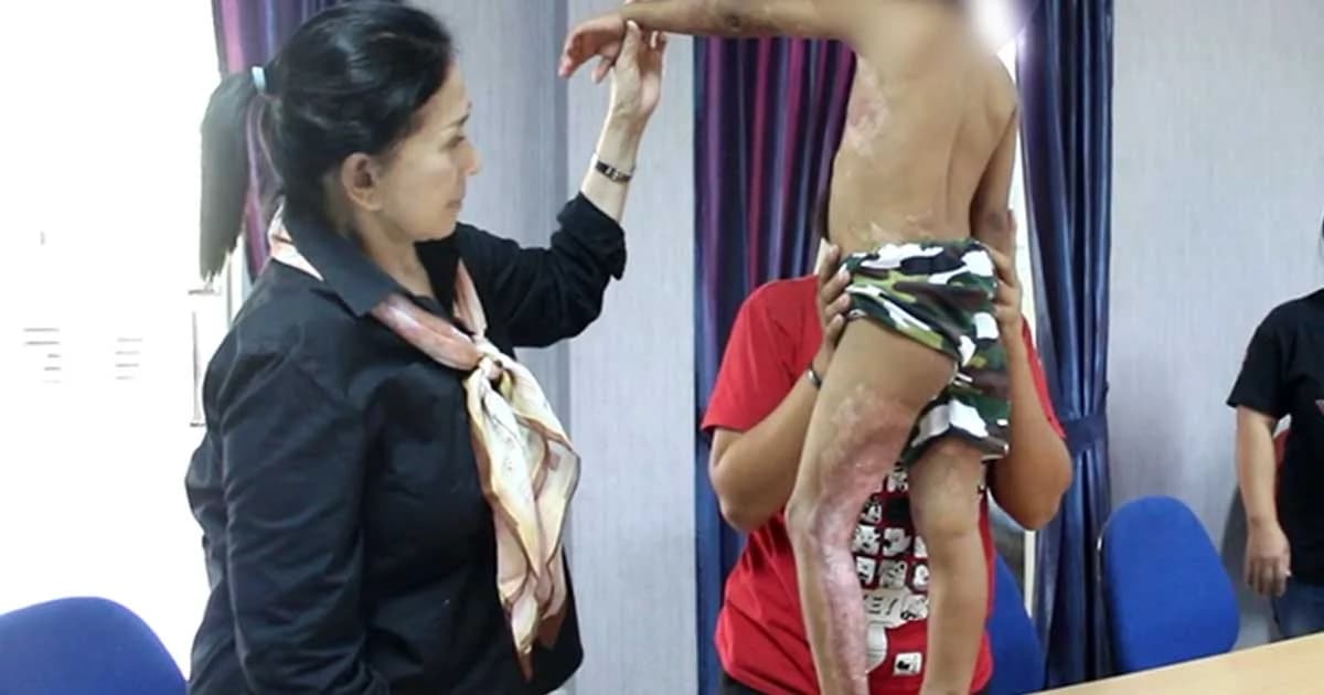 แม่ร้องปวีณา ลูกชาย 4 ขวบ ถูกเด็ก 7 ขวบ เตะขวดน้ำมันใส่ไฟลุกท่วมตัว