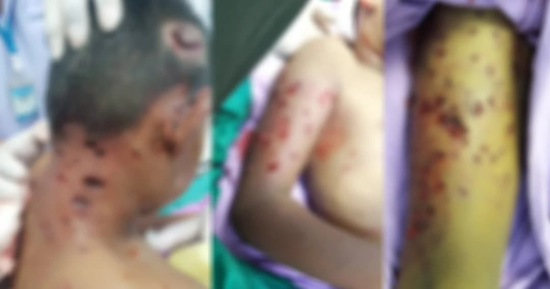 สุนัขจรรุมกัดเด็กชาย 7 ขวบ อาการสาหัส