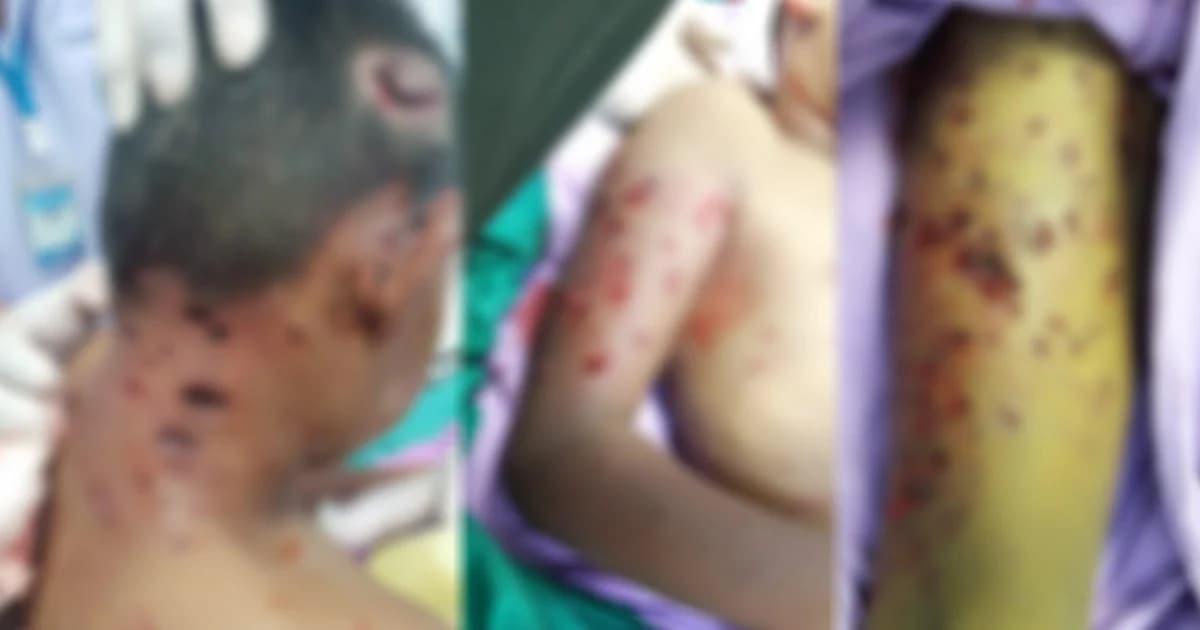 สุนัขจรรุมกัดเด็กชาย 7 ขวบ อาการสาหัส