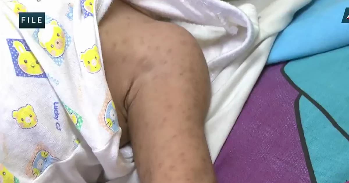 หัดระบาดรุนแรงในฟิลิปปินส์ ดับแล้ว 136 ราย ป่วยเกือบหมื่นราย