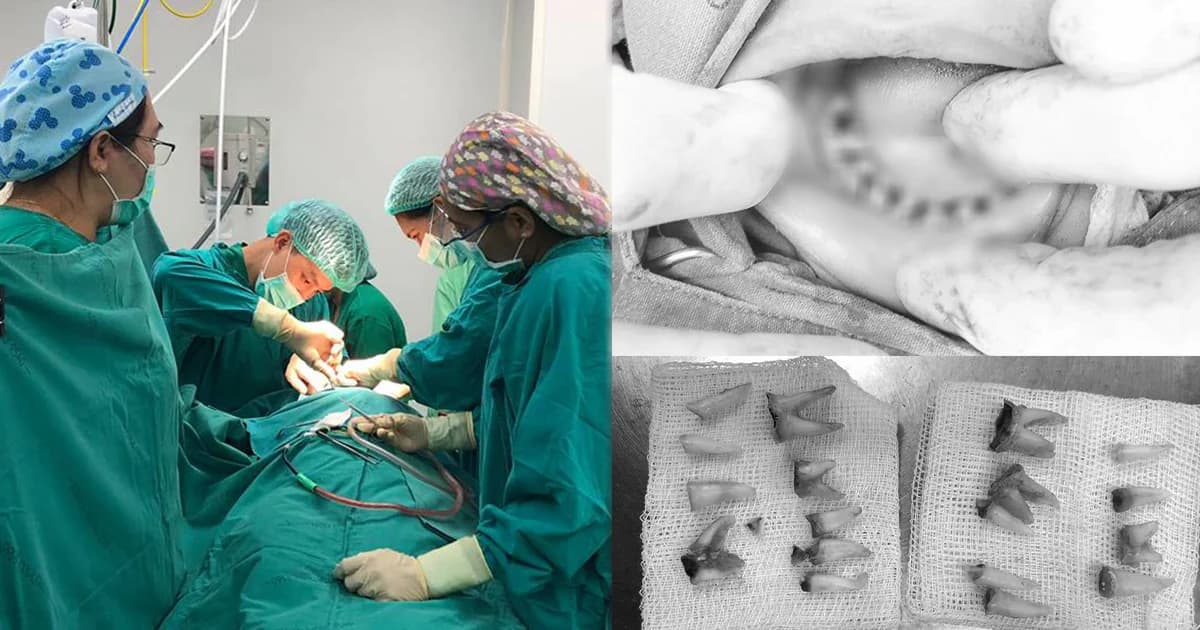 อุทาหรณ์! เด็กน้อยวัย 4 ขวบ ถูกถอนฟันผุเกือบทั้งปากเพราะติดขวดนม