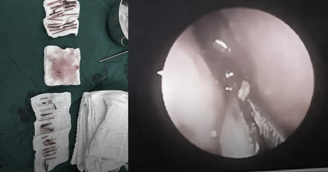 ผอ.รพ.สิชล เผยพบเศษไม้ปริศนา 40 ชิ้นในโพรงจมูกคนไข้ชายวัย 46 ปี หลังลมหายใจกลิ่นแรง