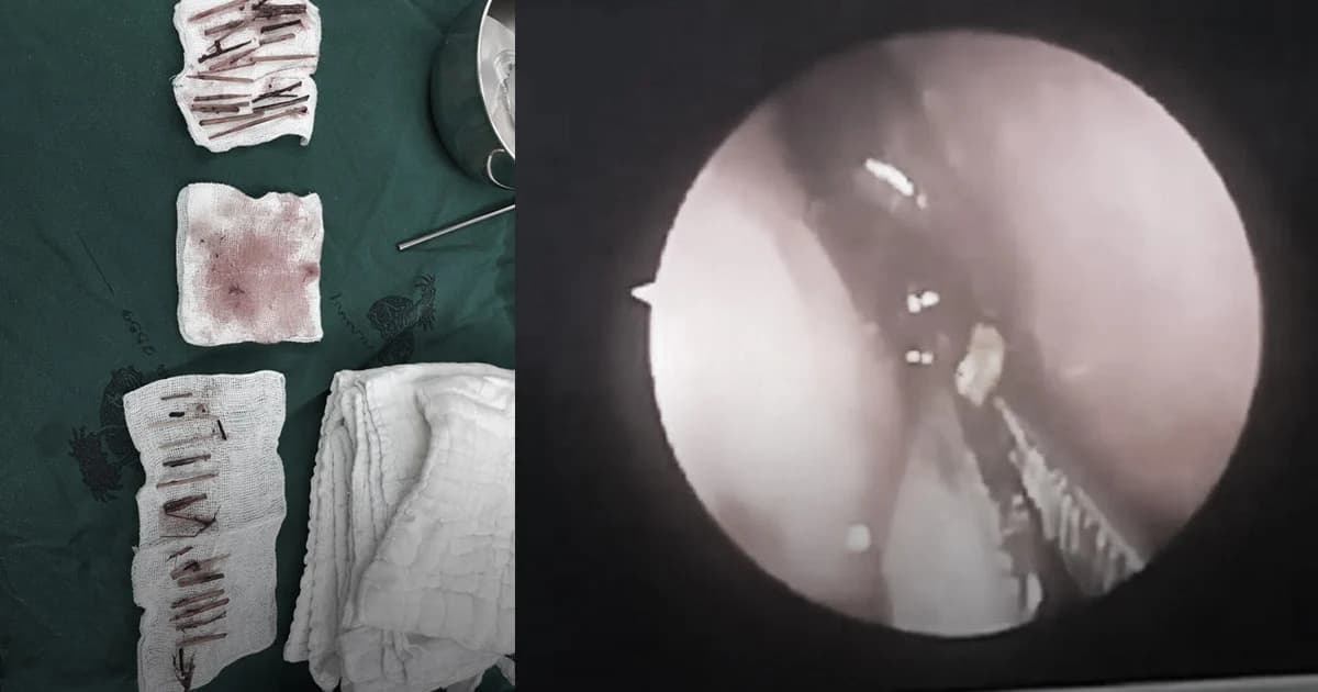 ผอ.รพ.สิชล เผยพบเศษไม้ปริศนา 40 ชิ้นในโพรงจมูกคนไข้ชายวัย 46 ปี หลังลมหายใจกลิ่นแรง