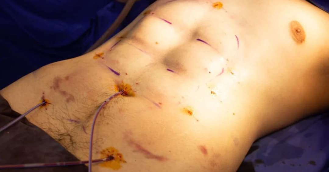 ศัลยกรรมแนวใหม่ มีซิกแพ็คได้ไม่ต้องรอ