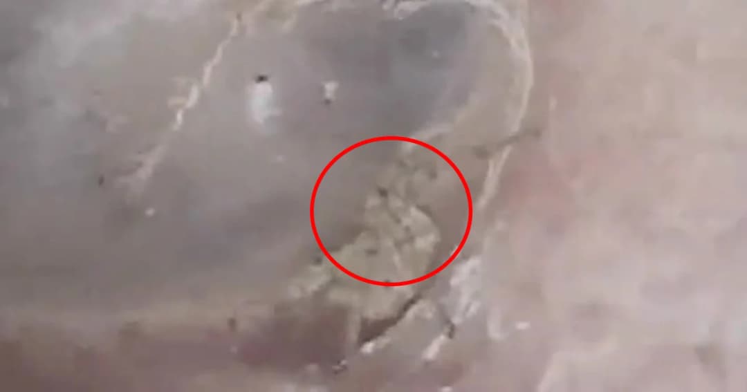 “หนุ่มจีนคันหู” หมอเจอแมงมุมกำลังชักสร้างข้างใน