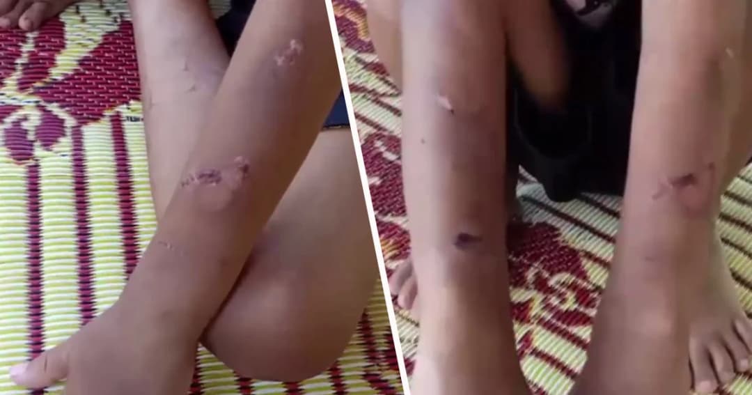 แจ้งจับพ่อเลี้ยงโหด โซ่ล่ามข้อเท้าทุบตี ด.ช. 9 ขวบ ทารุณ แผลเต็มตัว !