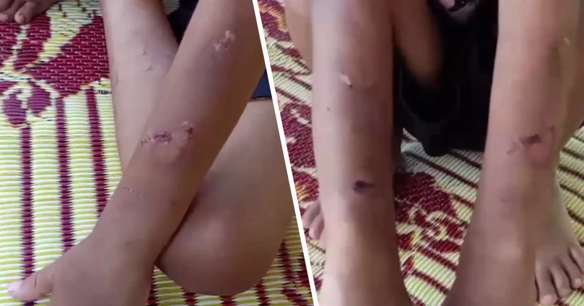 แจ้งจับพ่อเลี้ยงโหด โซ่ล่ามข้อเท้าทุบตี ด.ช. 9 ขวบ ทารุณ แผลเต็มตัว !