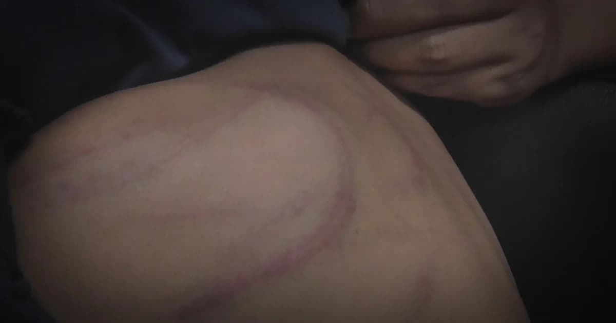 พ่อใช้ไม้แขวนกระหน่ำตีลูกสาววัย 10 ปี เหตุโมโหลูกไม่เก็บที่นอน จ.สมุทรปราการ