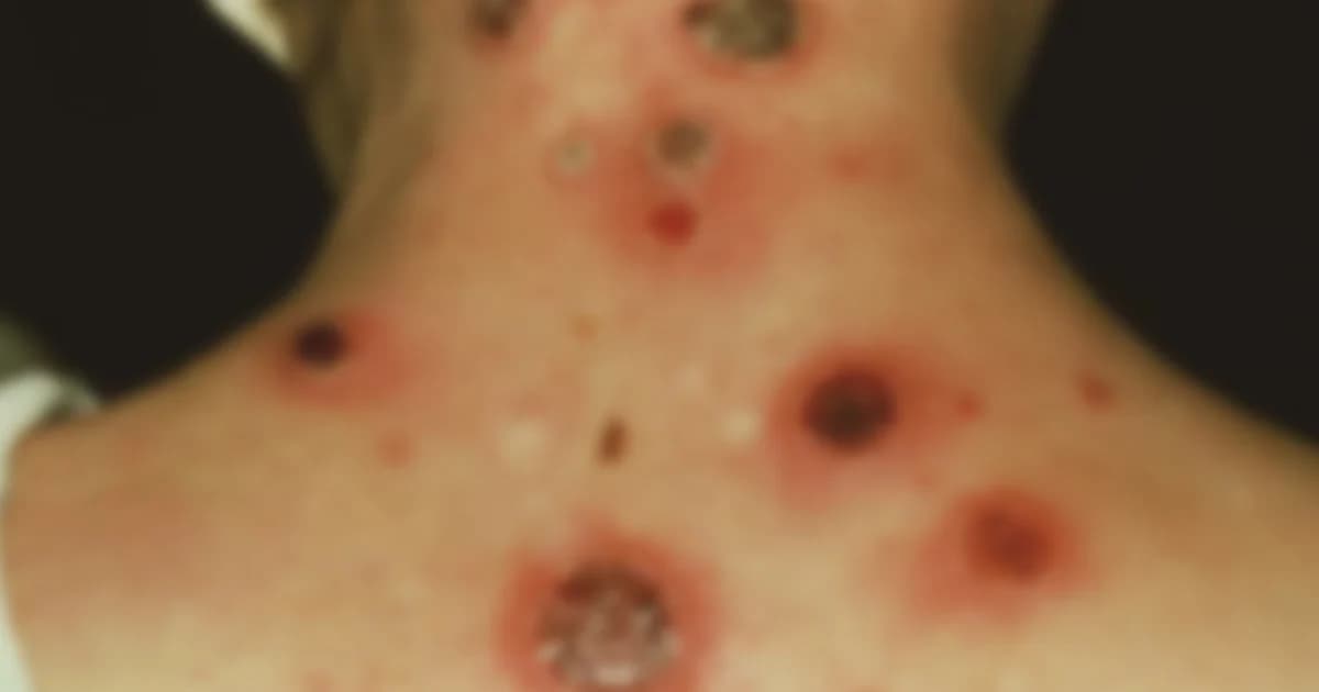 ซิฟิลิสระบาดในกลุ่มวัยรุ่น เพราะมีเพศสัมพันธ์กันโดยไม่ป้องกัน