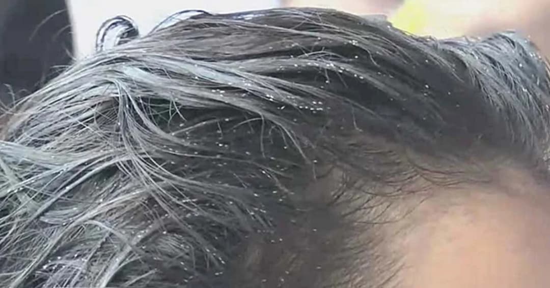 สาธารณสุขแนะ กำจัดเหาด้วยวิธีภูมิปัญญาท้องถิ่น เตรียมพร้อมก่อนเปิดเทอม