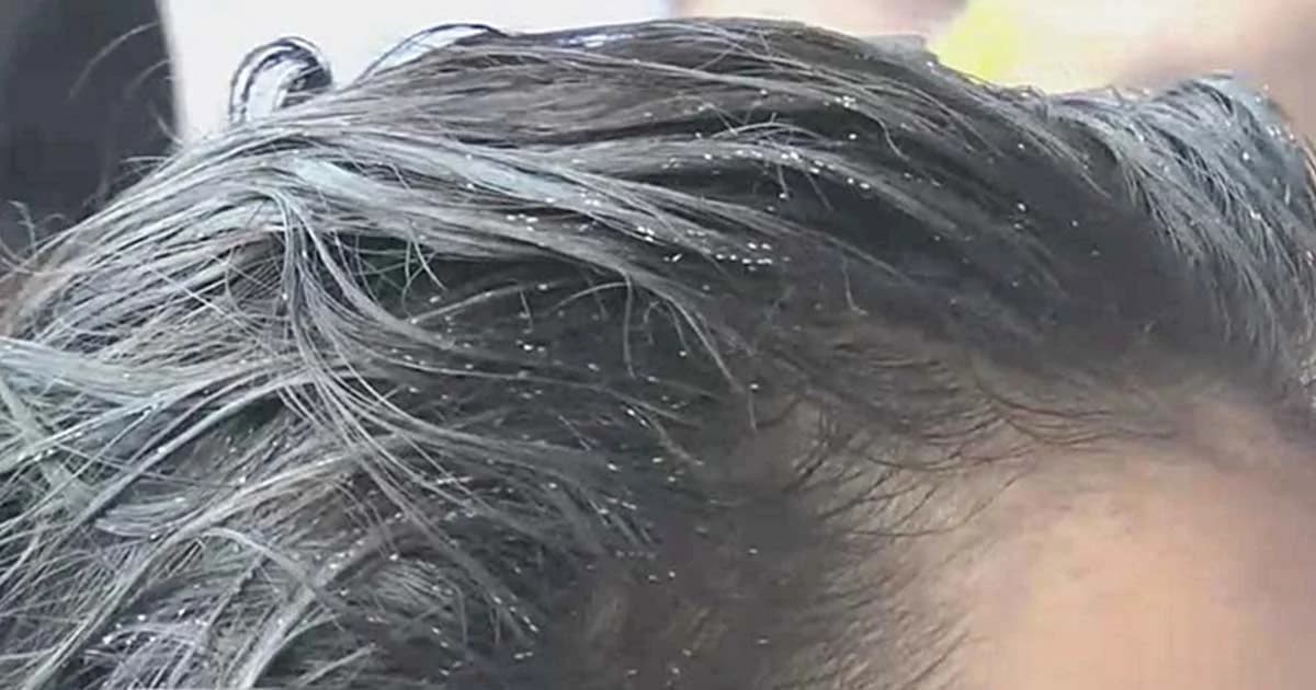 สาธารณสุขแนะ กำจัดเหาด้วยวิธีภูมิปัญญาท้องถิ่น เตรียมพร้อมก่อนเปิดเทอม