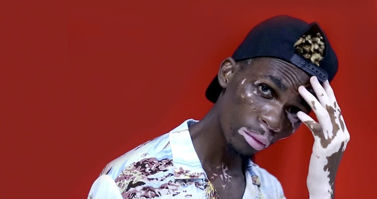 เปิดชีวิต มิกี ดีโอ นายแบบผู้เป็นโรคด่างขาว “ทุกชีวิตมีเอกลักษณ์ของตนเอง”