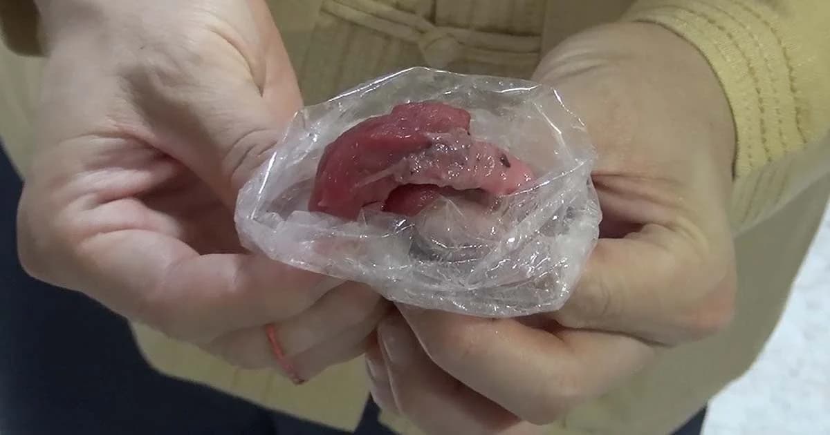 สธ.เตือน! “กินหมูดิบ” เสี่ยงโรคไข้หูดับ แนะควรปรุงสุก