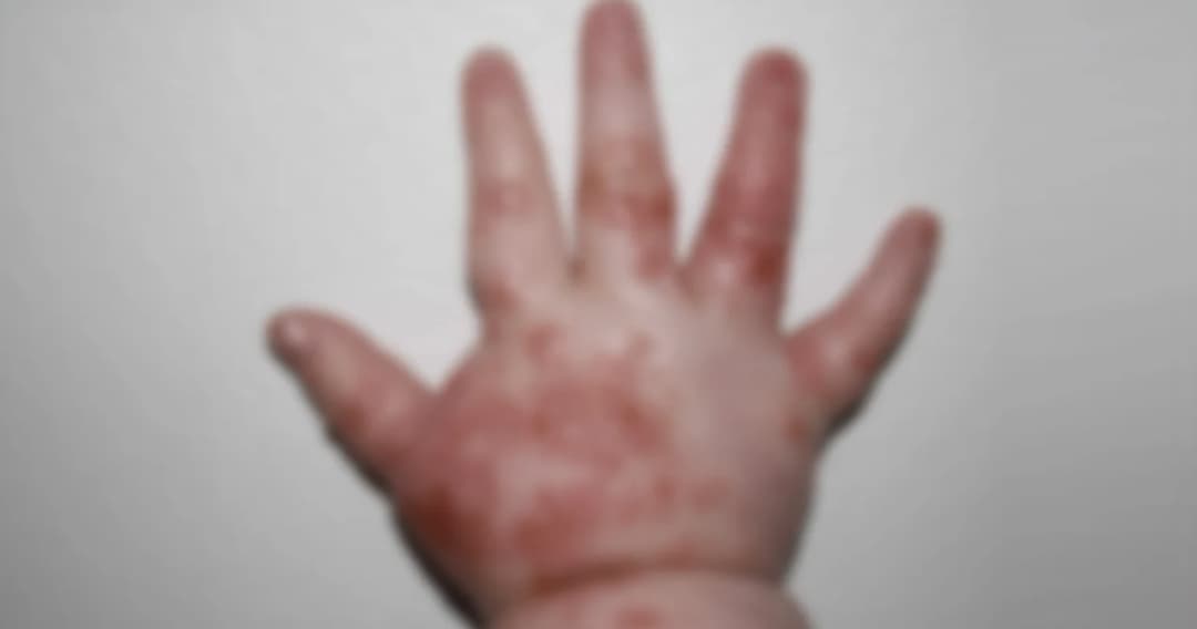 โรคมือเท้าปาก ภัยร้ายสำหรับเด็กที่มากับหน้าฝน