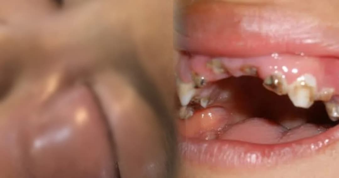 เด็ก 3 ขวบฟันผุติดเชื้อรุนแรง หนองขึ้นตาหวิดบอด