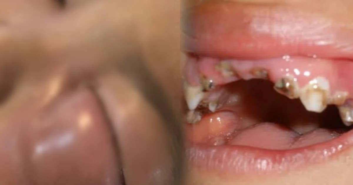 เด็ก 3 ขวบฟันผุติดเชื้อรุนแรง หนองขึ้นตาหวิดบอด