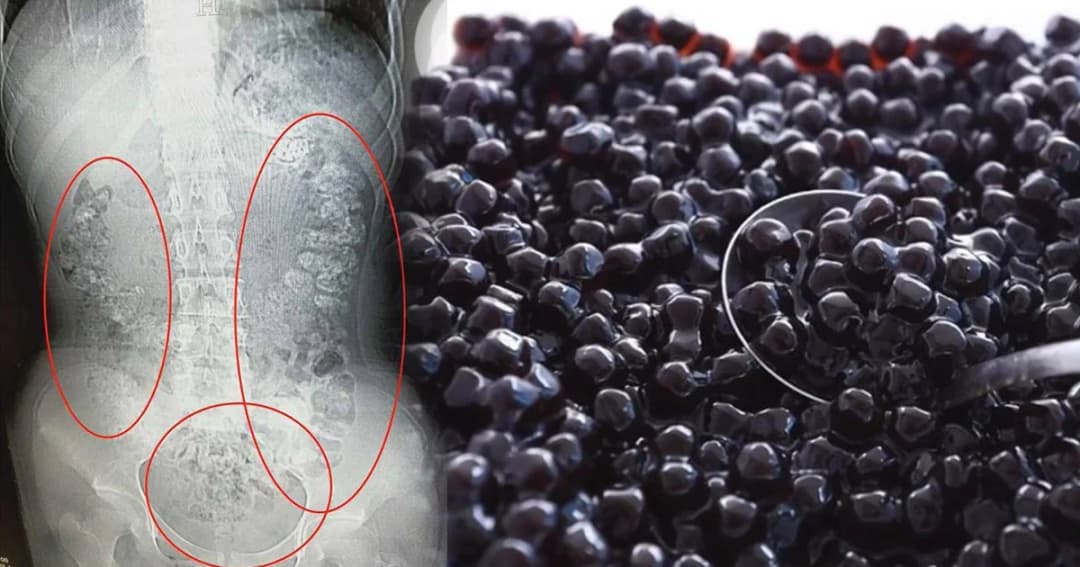 แพทย์รามาฯ แจงชาไข่มุกไม่ทำให้ลำไส้อุดตัน ยกเว้นสิ่งที่ผสมในไข่มุก