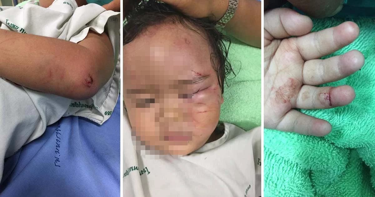 รร.ยืนยันเด็กตีกันจริง หลังเด็กหญิงวัย 2 ขวบ ถูกเพื่อนทำร้าย ตาบวมช้ำ รอยข่วนเต็มตัว