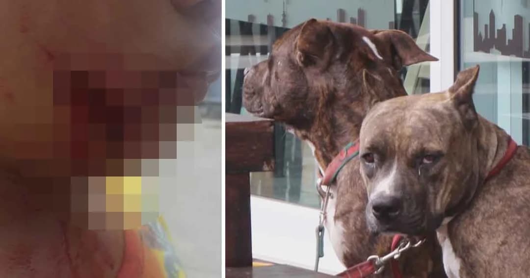 เด็กชายวัย 11 ปีผวา! ถูกพิตบูลรุมขย้ำ แม่เตรียมแจ้งความ หากเจ้าของไม่ย้ายสุนัขออกจากพื้นที่