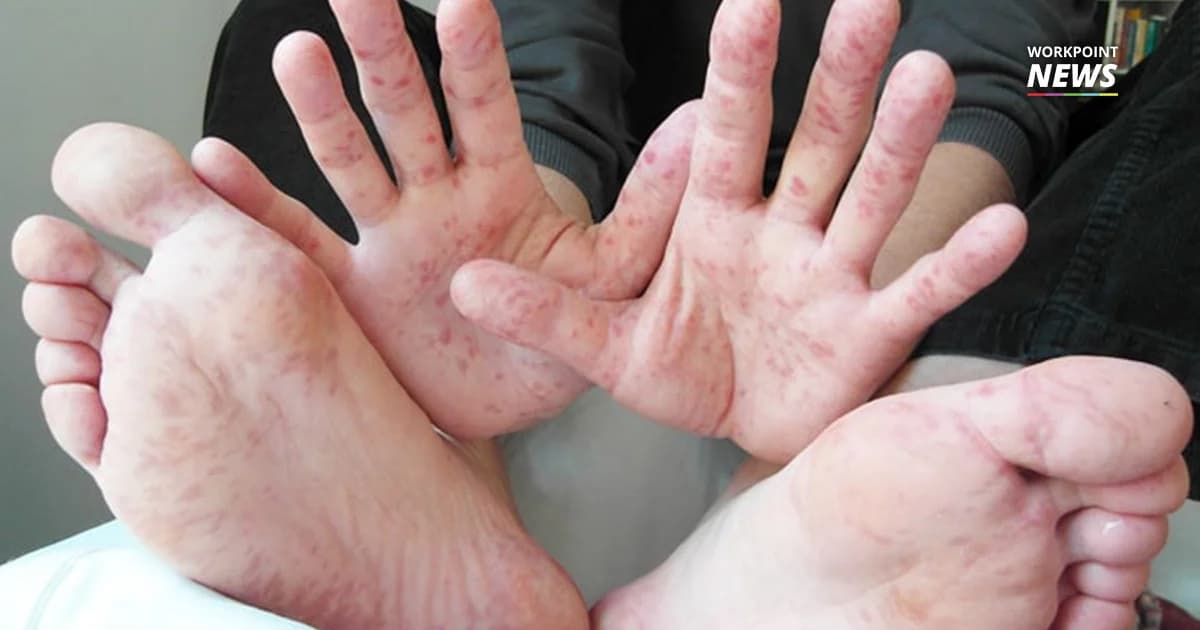 โรคมือ เท้า ปาก ระบาดพบมีผู้ป่วยแล้ว 1.4 หมื่นรายและมีแนวโน้มเพิ่มขึ้น