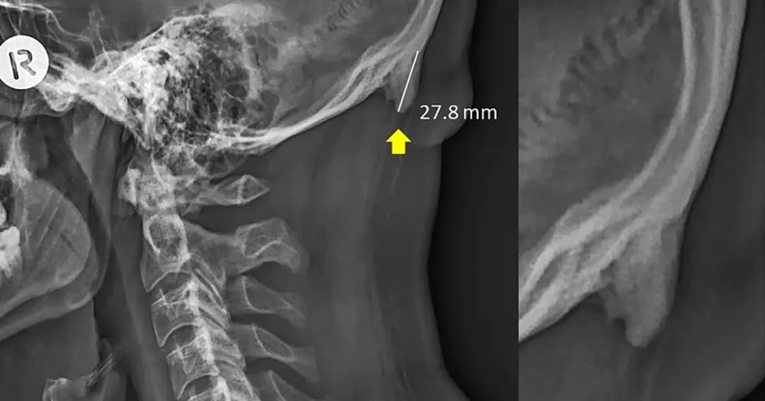 นักวิจัยออสเตรเลีย พบกระดูกงอกออกจากกะโหลกของกลุ่มวัยรุ่น คาดว่าเกิดจากใช้มือถือมากไป