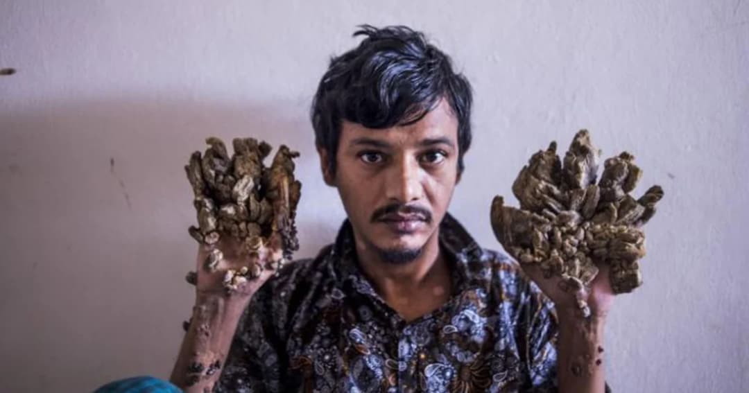 มนุษย์ต้นไม้ชาวบังกลาเทศ ท้ออยากตัดมือทิ้ง