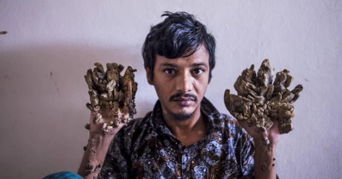 มนุษย์ต้นไม้ชาวบังกลาเทศ ท้ออยากตัดมือทิ้ง