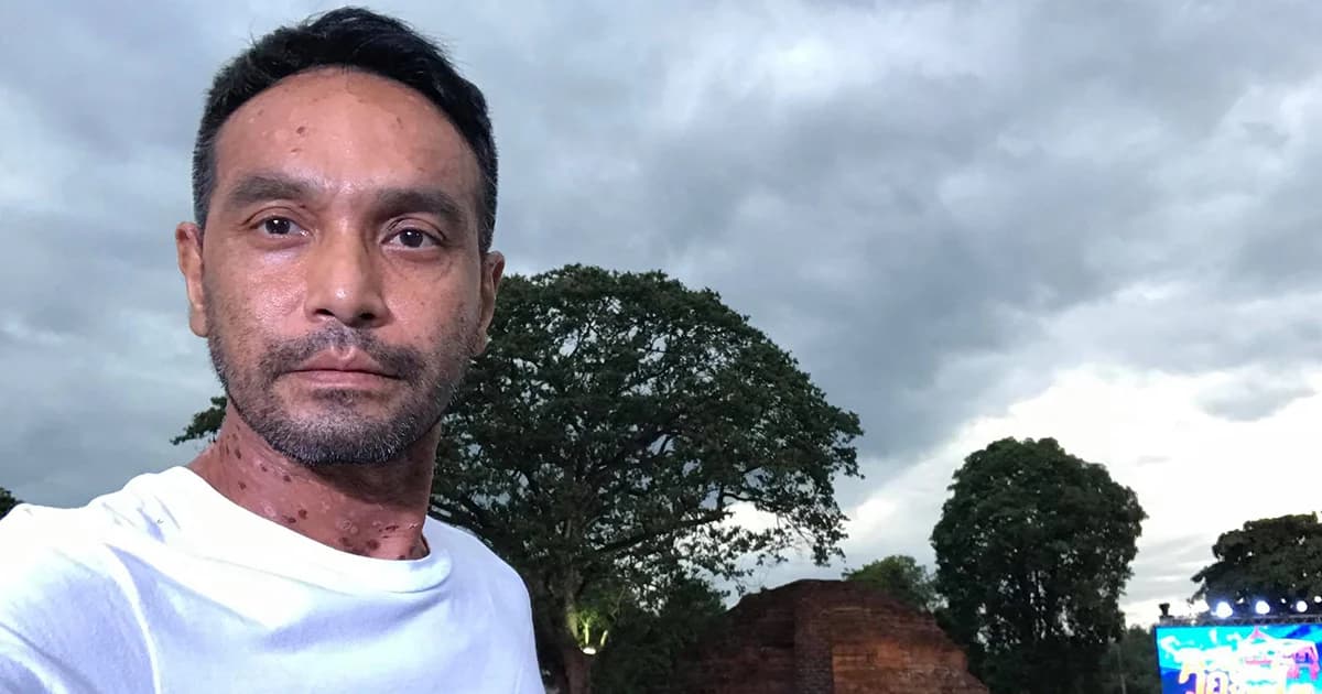 แพทย์ผิวหนัง ชี้ โรคตุ่มน้ำพองใส ‘วินัย ไกรบุตร’ ไม่ใช่โรคติดต่อ